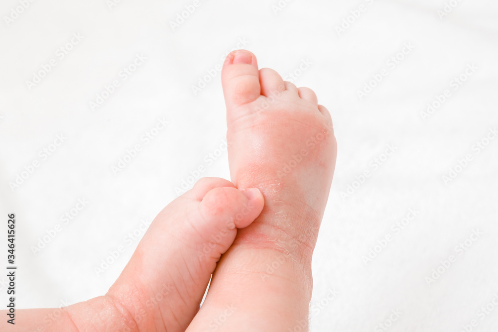Infant legs with red dry skin. Suffering from allergy of milk formula or other food. Closeup. Infant legs with red dry skin. Suffering from allergy of milk formula or other food. Closeup.