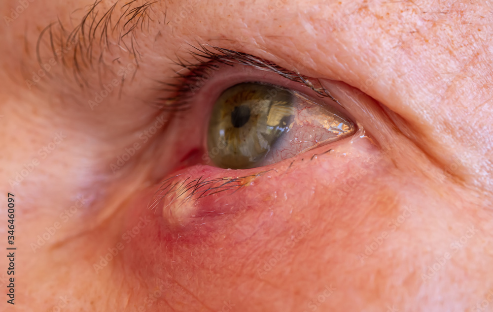 Φωτογραφία Stye or hordeolum and blepharitis in right lower eyelid of a woman