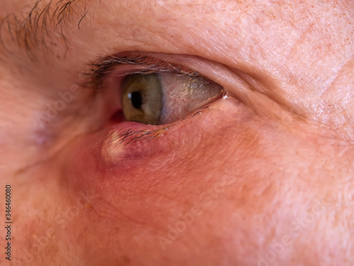 Stye or hordeolum and blepharitis in right lower eyelid of a woman. It is a bacterial infection of an oil gland. 