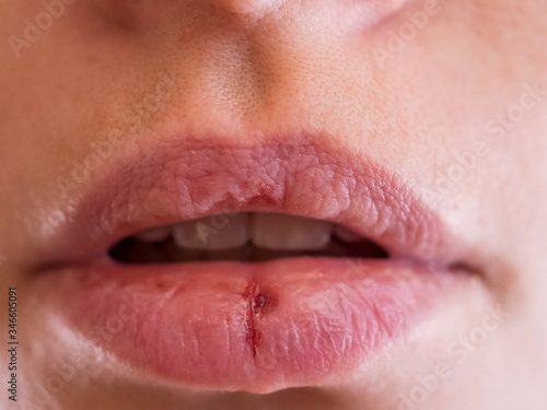 Close-up pale female lips cracked from frost, wind, lack of vitamins. Herpes disease virus wound. Lips need hygiene. Mature woman 35 years oldsuffering from herpes