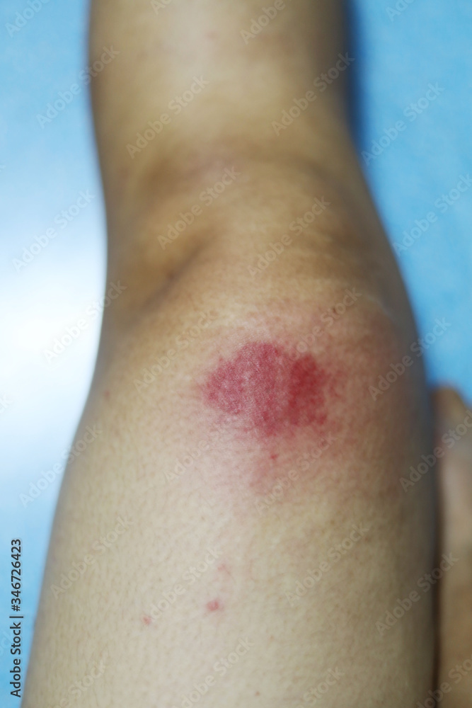 Fototapeta premium Insect bite wounds at leg in thailand