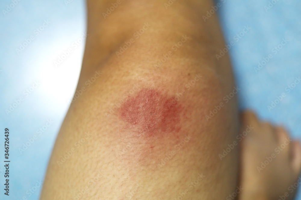 Insect bite wounds at leg in thailand Insect bite wounds at leg in thailand