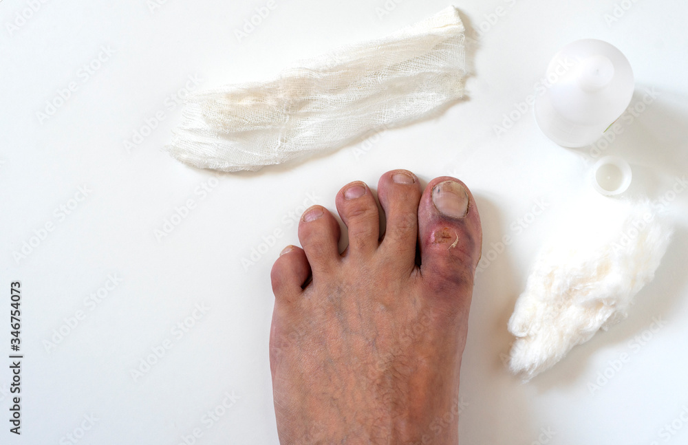 A closeup photo of a broken big toe with several cuts and bruises. The