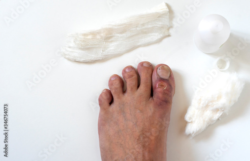 A close-up photo of a broken big toe with several cuts and bruises. The first medical aid. Top view. Isolated on white background. photo