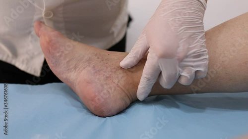 Chinese doctor doing acupuncture on the foot of a patient