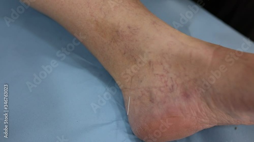 Chinese doctor doing acupuncture on the foot of a patient