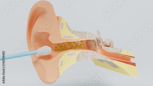 3d render ear cleansing ear stick. cleansing earwax with an ear stick