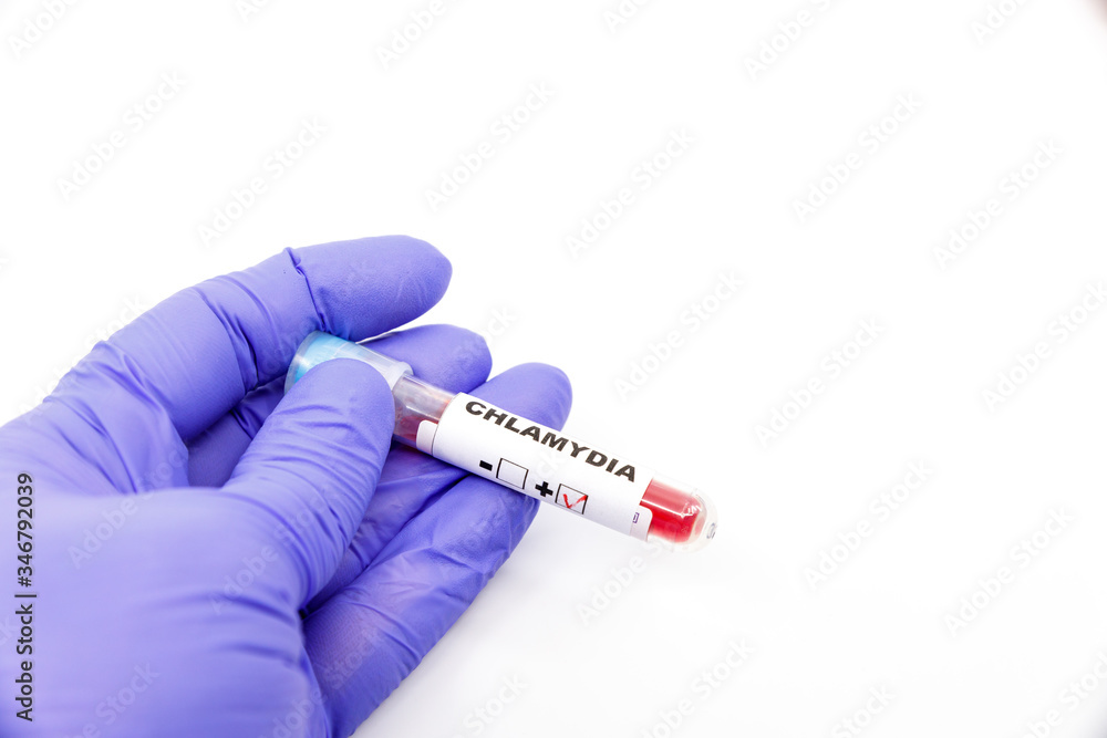 Obraz premium Closeup of microbiologist or medical worker hand with blue surgical gloves marking blood test result as positive for the chlamydia. Chlamydia Positive concept