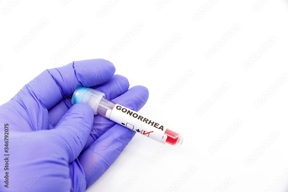 Naklejka premium Closeup of microbiologist or medical worker hand with blue surgical gloves marking blood test result as positive for the gonorrhea. Gonorrhea Positive concept