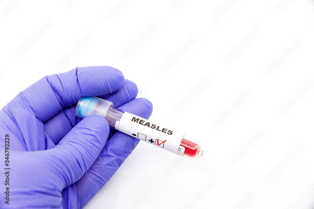 Obraz premium Closeup of microbiologist or medical worker hand with blue surgical gloves marking blood test result as positive for the measles. Measles Positive concept