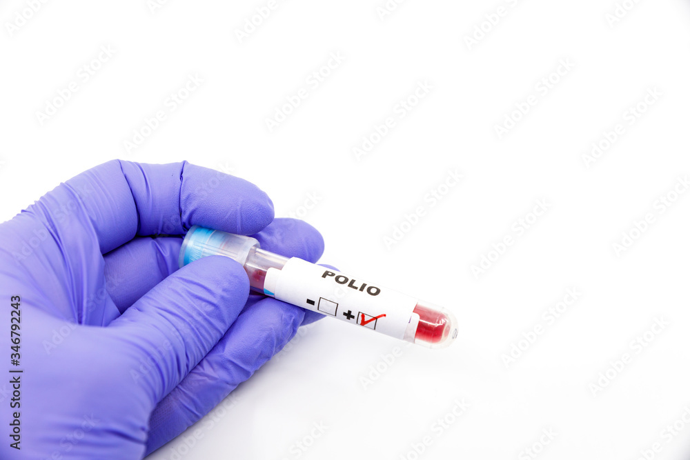 Fototapeta premium Closeup of microbiologist or medical worker hand with blue surgical gloves marking blood test result as positive for the polio. Polio Positive concept