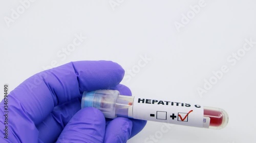 Closeup of microbiologist or medical worker hand with blue surgical gloves marking blood test result as positive for the hepatitis C. Hepatitis C Positive concept