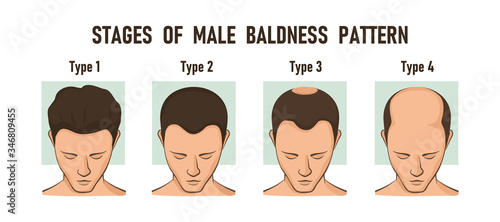 Stages of male baldness pattern. Male hair loss