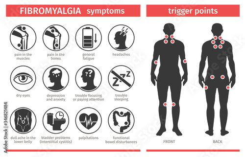 Symptoms and signs of fibromyalgia. Tender points. Infographic. Template for use in medical agitation. Vector illustration, flat icons.
