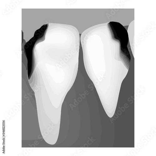 Dental caries. X-ray of tooth decay. Caries infographics. Vector illustration on isolated background.