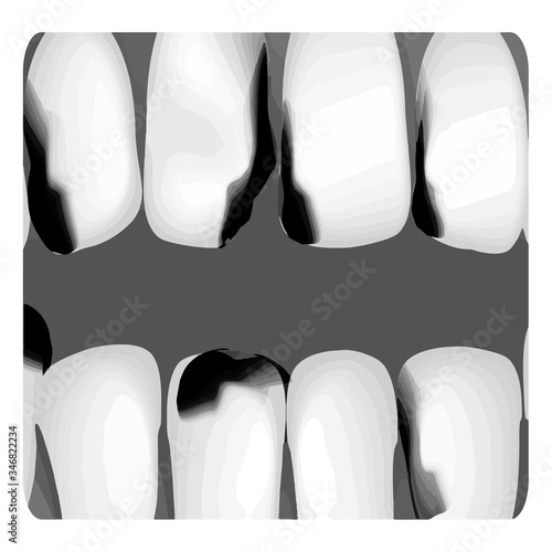 Dental caries. X-ray of tooth decay. Caries infographics. Vector illustration on isolated background.