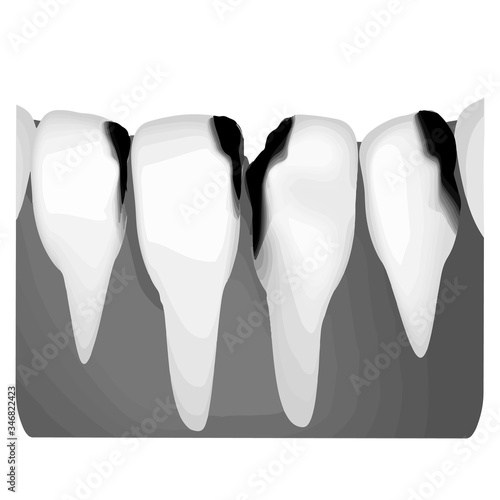 Dental caries. X-ray of tooth decay. Caries infographics. Vector illustration on isolated background.
