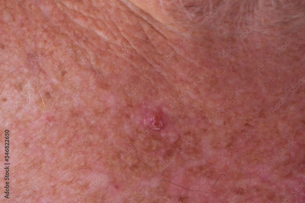 Fototapeta premium BCC skin cancer on chest of senior male