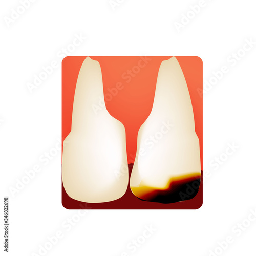 Dental caries. tooth decay. Caries infographics. Vector illustration on isolated background.