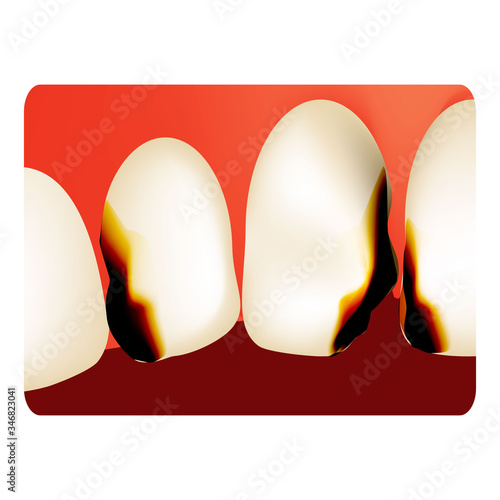Dental caries. tooth decay. Caries infographics. Vector illustration on isolated background.