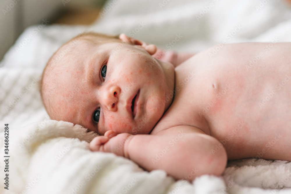 Baby acne, small red and purulent inflammations on the skin of the face of a one-month-old baby. How to distinguish from atopic dermatitis, allergies Baby acne, small red and purulent inflammations on the skin of the face of a one-month-old baby. How to distinguish from atopic dermatitis, allergies