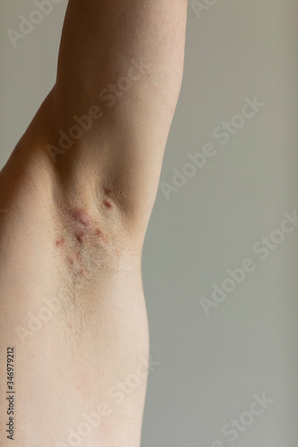 Patient diagnosed with Crohn’s disease with hidradenitis suppurativa under his armit with visible red painful fistulas. Irritated skin and hair follicles, abcess. Close up, vertical