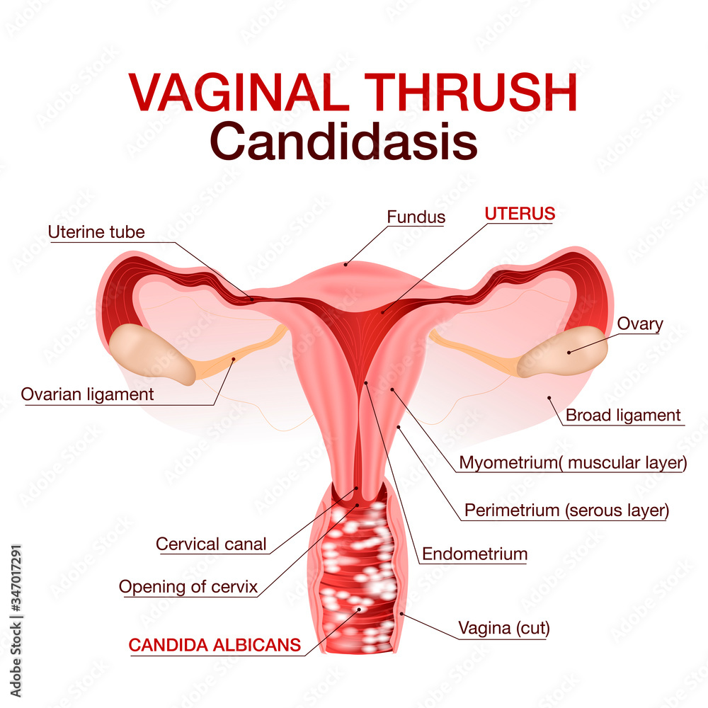 Canddiasis Female Yeast Infection