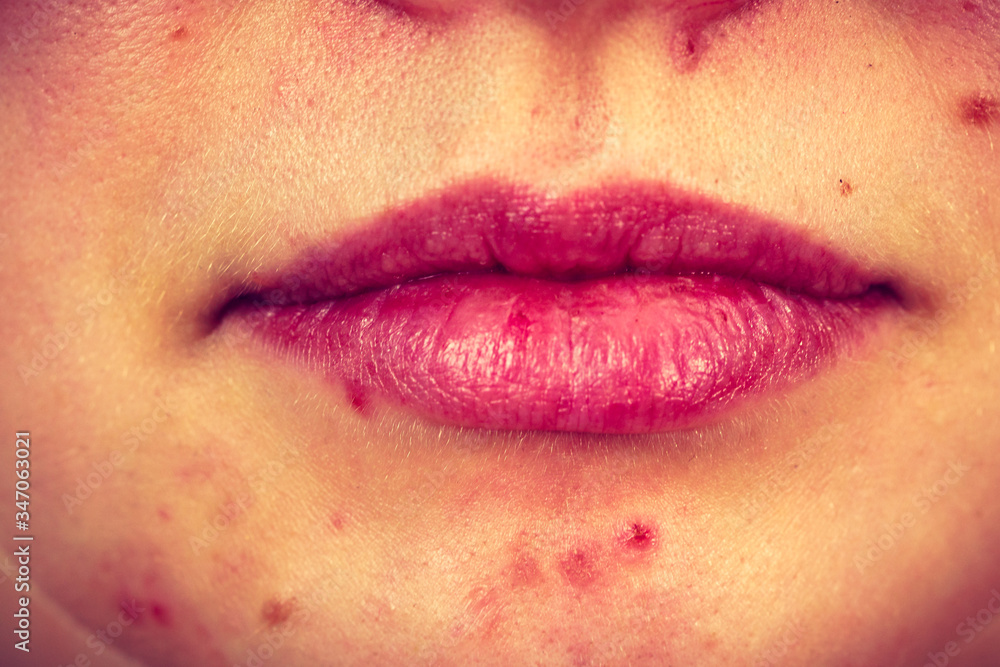 Fototapeta premium Female face with acne skin problem