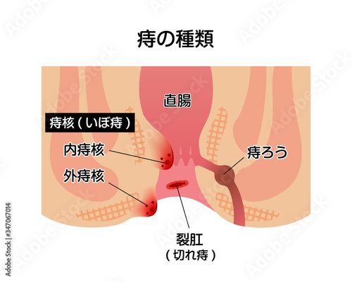痔のタイプ・種類 (肛門断面図イラスト) 