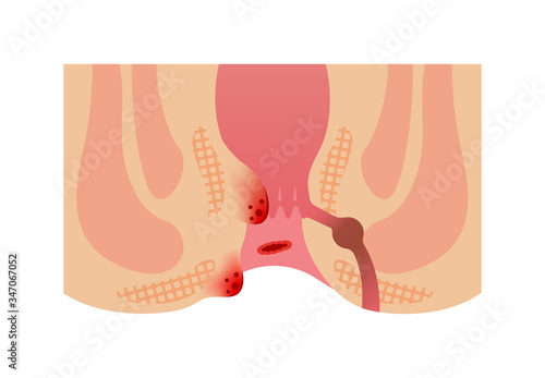 Types of Hemorrhoid flat vector illustration ( no text )