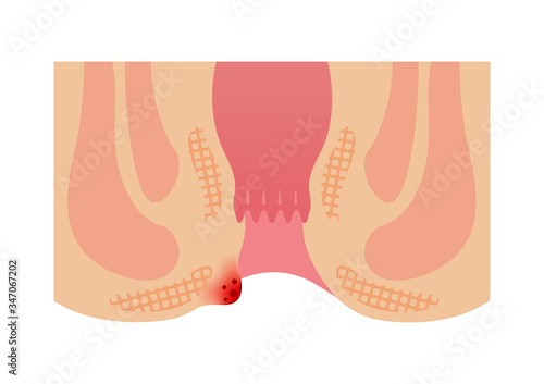 Type of Hemorrhoid flat vector illustration / External hemorrhoid