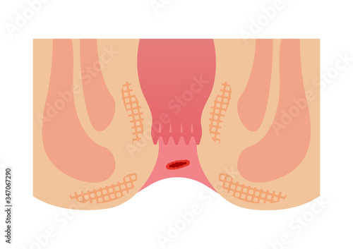 Type of Hemorrhoid flat vector illustration / bleeding hemorrhoids