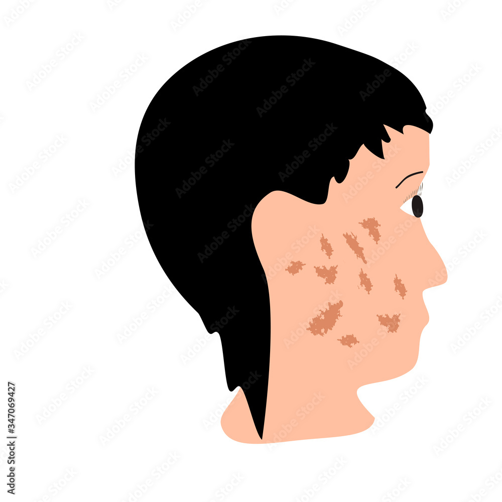 Pigmentation on the skin. A pigmented spot on the skin of the face. Vector illustration Pigmentation on the skin. A pigmented spot on the skin of the face. Vector illustration