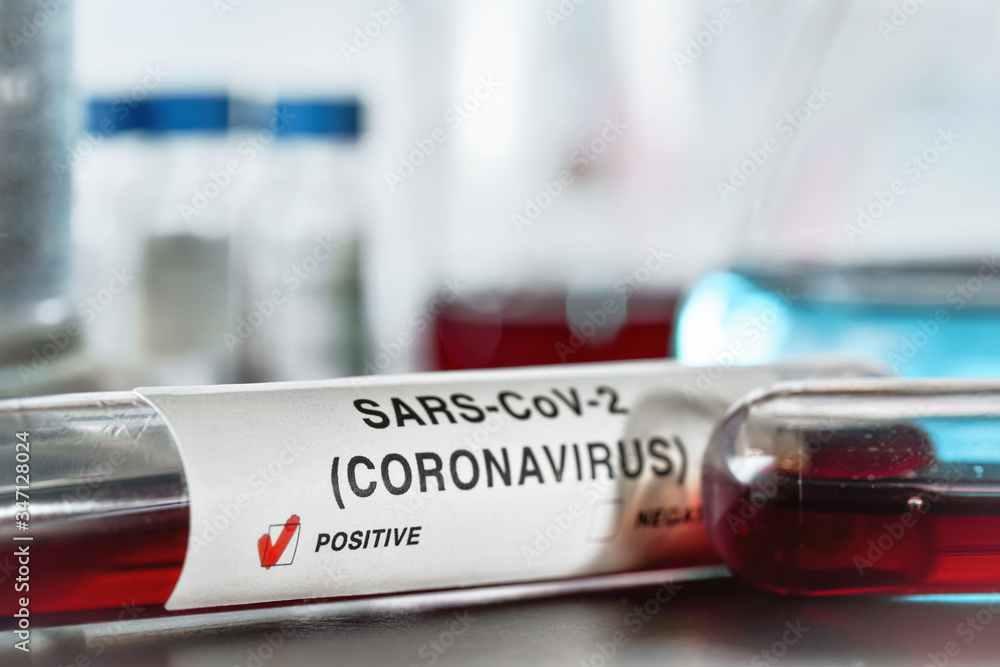 Sample vial with blood, label says coronavirus test, positive result. Blurred laboratory equipment background. Covid 19 outbreak concept