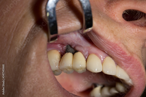 FAILING DENTAL IMPLANT