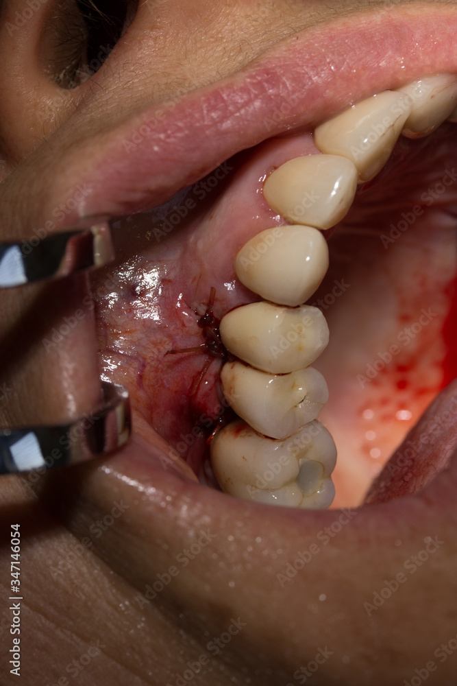Obraz premium repositioning gingival tissue