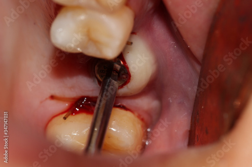 pre extraction implant placement