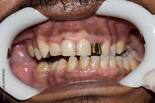 gold tooth in front of mouth