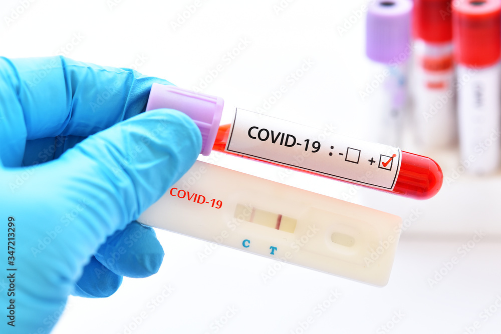 Positive test result by using rapid test device for COVID-19 virus Positive test result by using rapid test device for COVID-19 virus