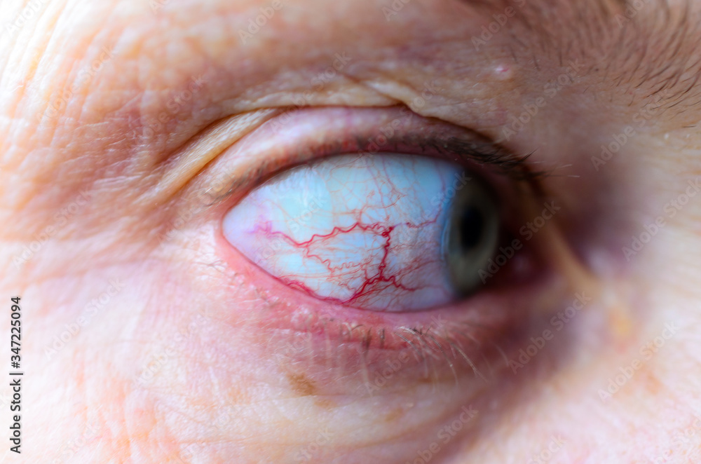 eye with red blood vessels macro Stock Photo Adobe Stock