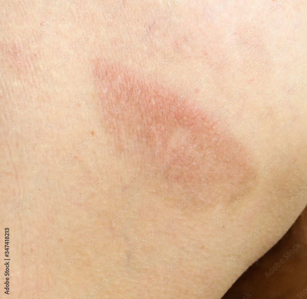 Fototapeta premium Bruise on human skin as a background.