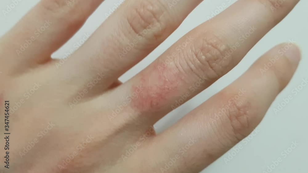 Skin and neurological diseases. Redness on the finger of the hand