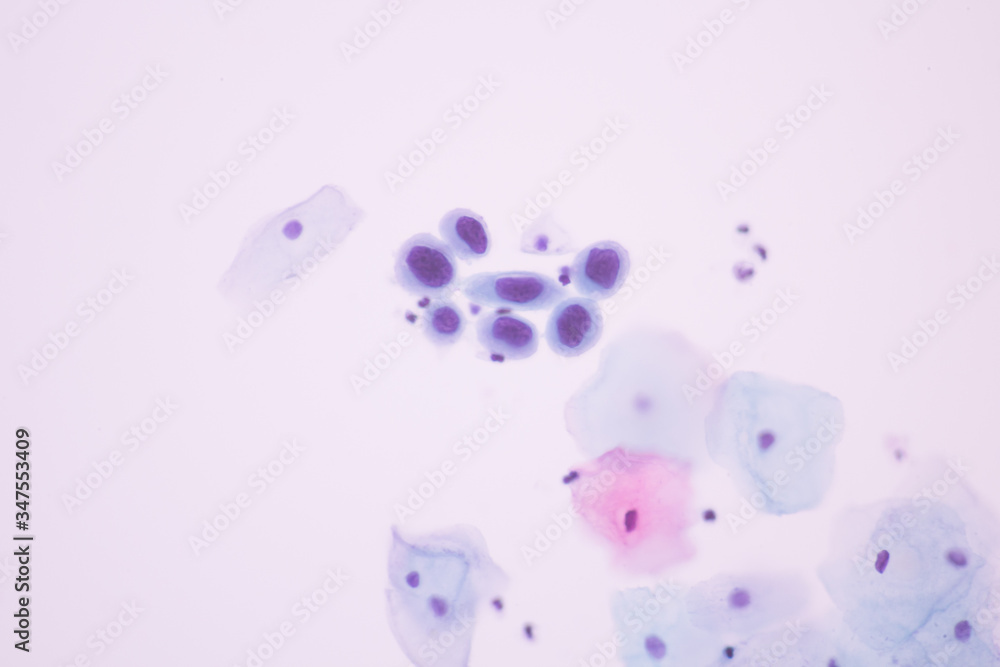 View in microscopic of Abnormal human cervical cells.Squamous epithelium cells.Superficial and intermediate epithelial cells.Cytology and pathology laboratory department.Magnification 600 X View in microscopic of Abnormal human cervical cells.Squamous epithelium cells.Superficial and intermediate epithelial cells.Cytology and pathology laboratory department.Magnification 600 X