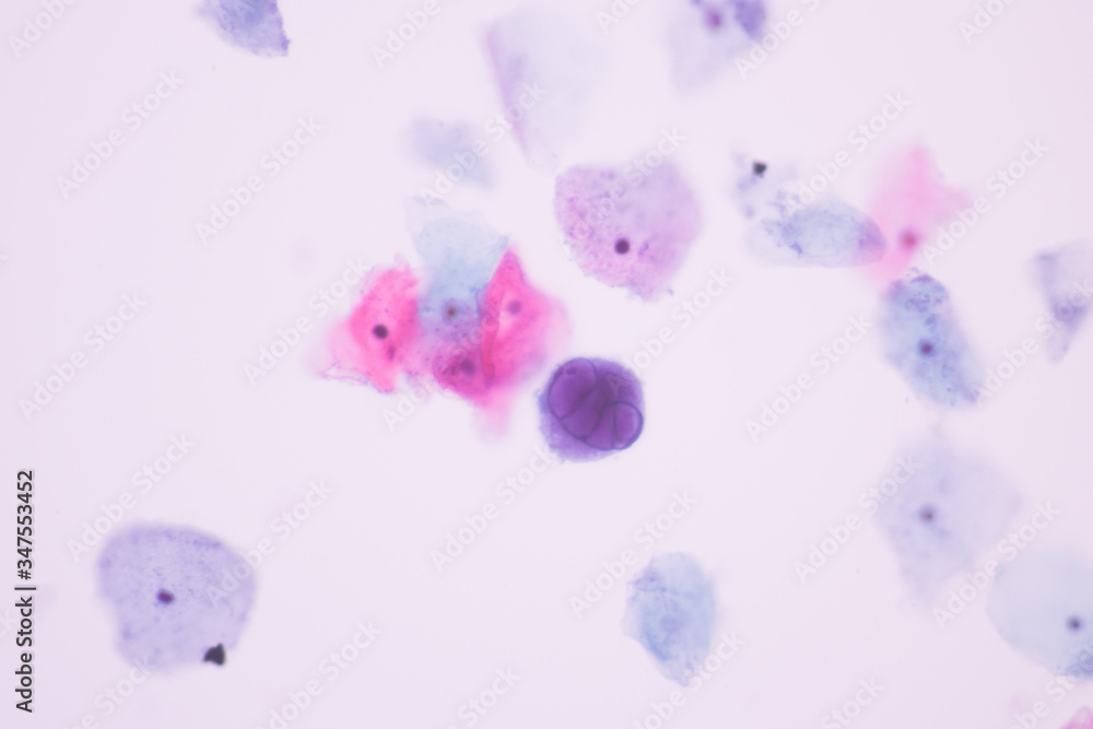 Image from microscopic of herpes simplex virus infection show ground glass  appearance criteria in human cervical pap smear slide.Cytology and  pathology diagnosis for skin infection disease concept. Photos | Adobe Stock