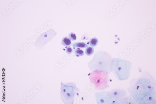 View in microscopic of Abnormal human cervical cells.Squamous epithelium cells.Superficial and intermediate epithelial cells.Cytology and pathology laboratory department.Magnification 600 X