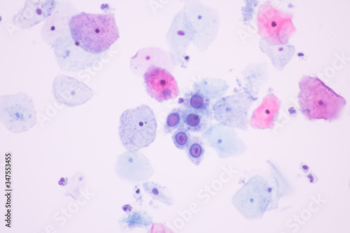 Photos Image from microscopic of herpes simplex virus infection show ground glass appearance criteria in human cervical pap smear slide