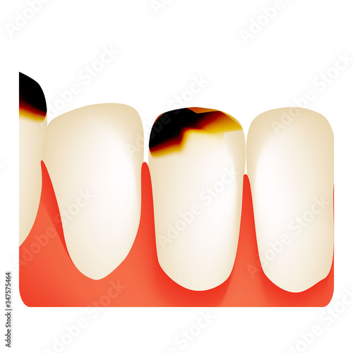 Dental caries. tooth decay. Caries infographics. Vector illustration on isolated background.