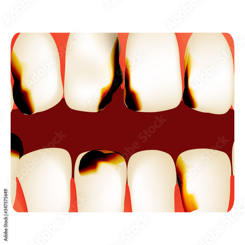 Dental caries. tooth decay. Caries infographics. Vector illustration on isolated background.