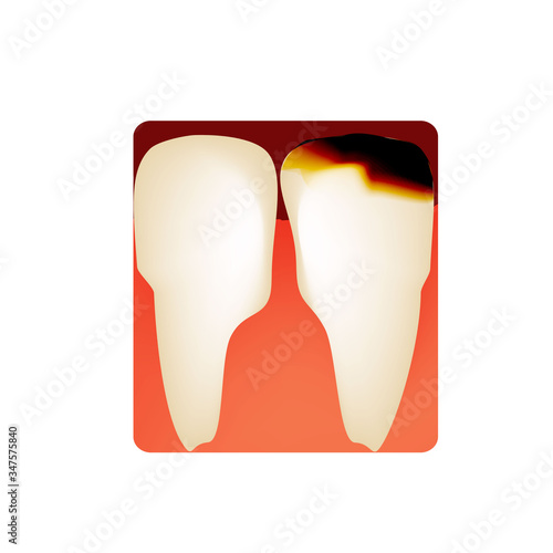 Dental caries. tooth decay. Caries infographics. Vector illustration on isolated background.