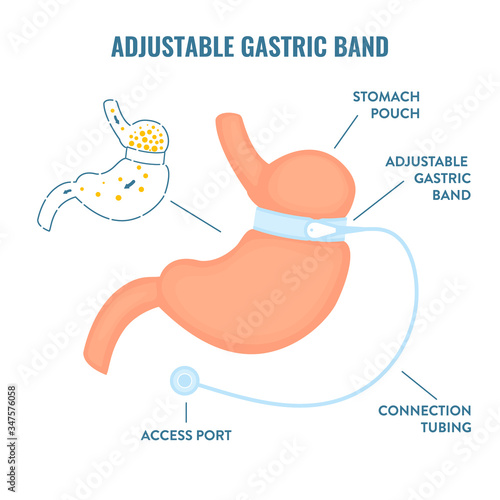 Stomach with adjustable gastric band device. Bariatric surgery weight loss procedure. Stomach reduction anatomical diagram infographics. Health care  medical concept. Vector illustration.